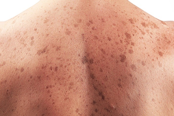 افرادی که پوست روشن دارند بیشتر به سرطان پوست مبتلا می شوند/ خطرناکترین نوع سرطان پوست را بشناسید