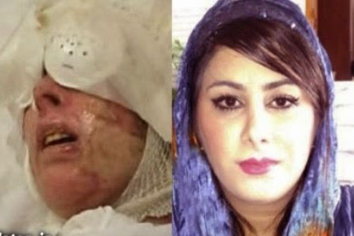 عمل دوباره قربانی اسیدپاشی به دستور وزیر بهداشت