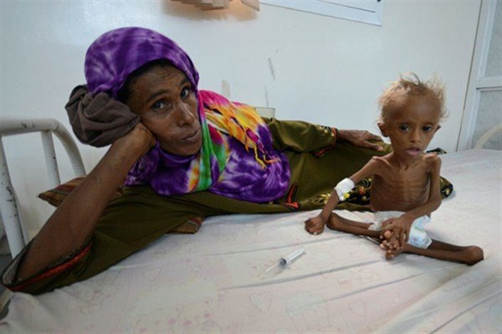 کودکان قحطی زده یمن؛ نمونه ای دیگر از جنایات عربستان سعودی