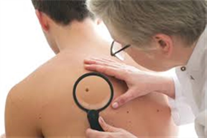  لک وخال پوستی جدیدمی تواند زنگ خطرسرطان پوست باشد/شایع ترین بیماری های پوستی در ایران