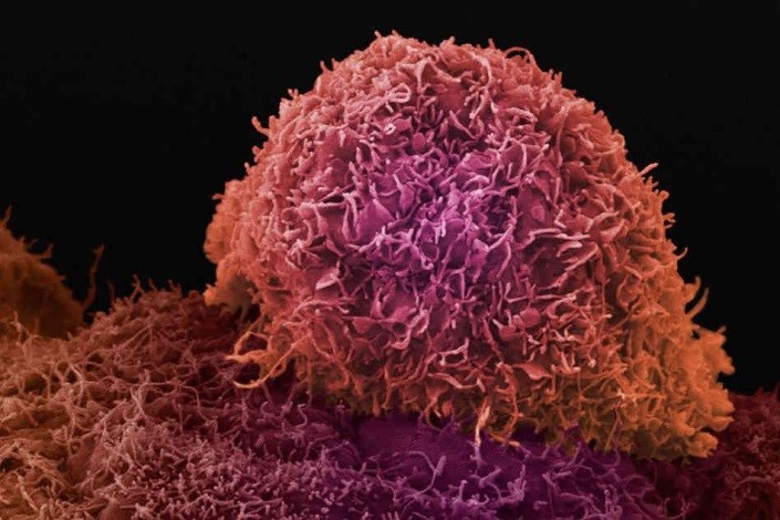  سلول درمانی سرطان با استفاده از سلول های دندریتیک