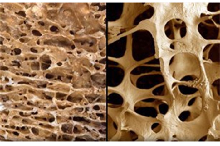 دکتر مصطفی سروش:  پوکی استخوان در زنان بیشتر از مردان است