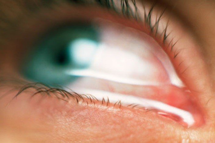 لنزهای کرایه ای آرایشگاه ها شایع ترین علت عفونت های چشمی/افراد سیگاری و قلیانی مراقب باشید!