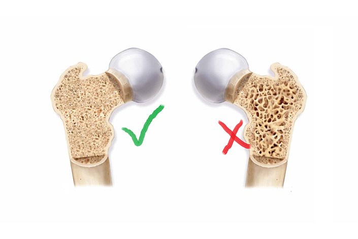 تغذیه مناسب و ورزش مهم‌ترین راه مقابله با پوکی استخوان
