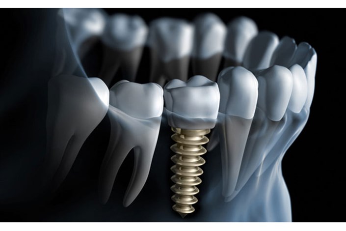 ضعف استخوان فک ، عمر ایمپلنت های دندانی را کاهش می دهد