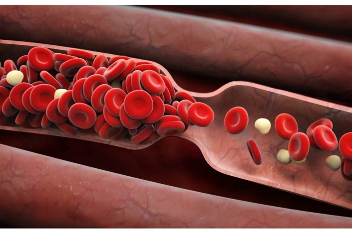 چگونه متوجه لخته خون در بدن شویم؟