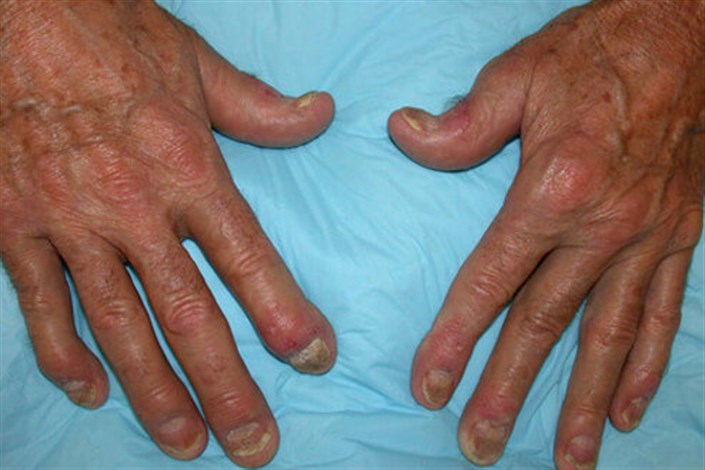 درمان‌های طبیعی برای عارضه "آرتریت پسوریاتیک"