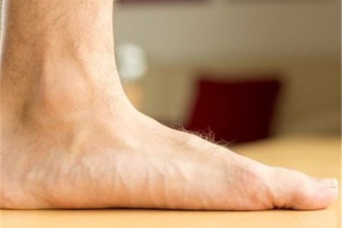 «گُرگرفتگی» کف پای خود را چگونه درمان کنیم