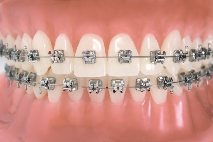 ارتودنسی؛ تنها راه ردیف کردن دندان‌ها است؟