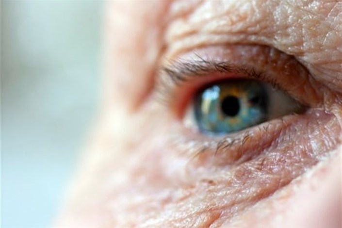 آسیب چشم از طریق بوتاکس و جراحی زیبایی