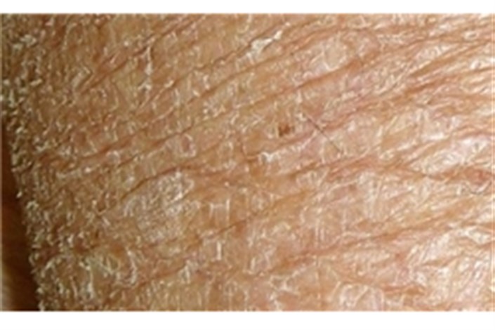 علت خشکی پوست در فصول سرد/ از کرم‌های چرب‌کننده استفاده شود