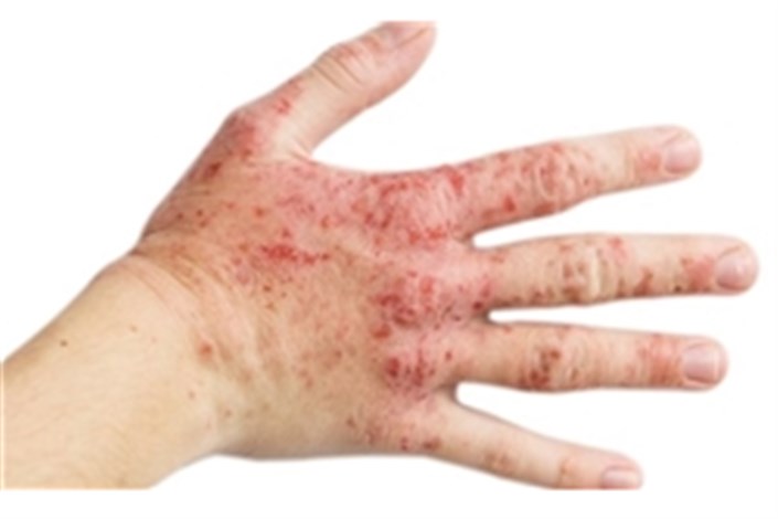 راهکارهای درمانی اگزمای پوست/۲۰ درصد اگزماهای تماسی از نوع آلرژیک هستند