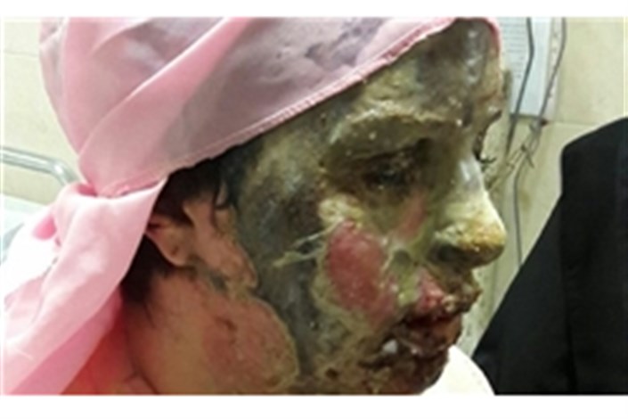درمان قربانی اسید پاشی در تبریز آغاز شد