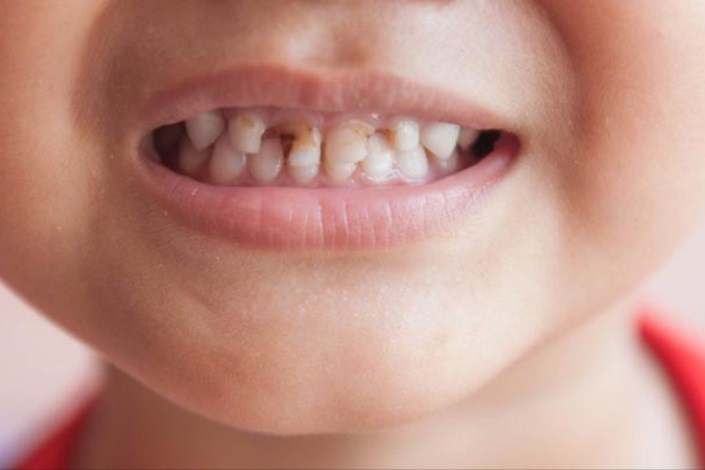 حدود90درصد کودکان 6ساله دچار پوسیدگی دندان هستند