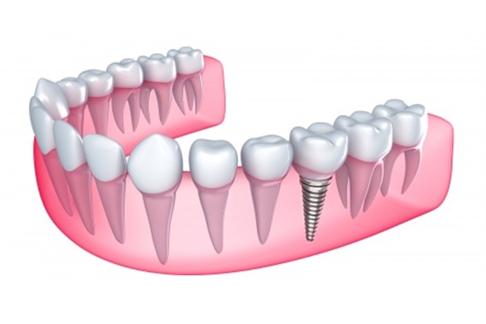 بهینه‌سازی طول تاج ایمپلنت دندانی و کمک به استحکام ایمپلنت و بافت‌های اطراف