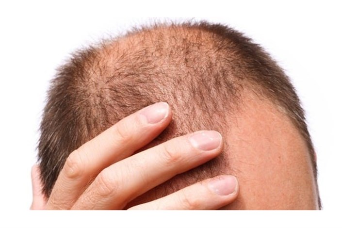 تبلیغ غیرقانونی محصول درمان ریزش موی «ب» در صدا و سیما