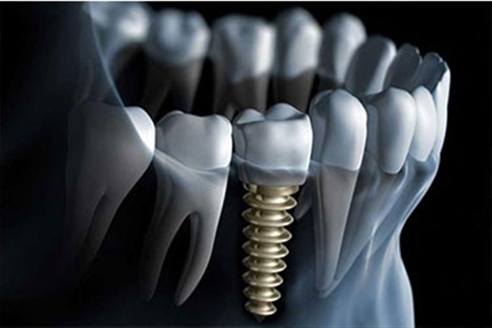 طراحی ایمپلنت دندانی به وسیله ابعاد استخوانی افراد