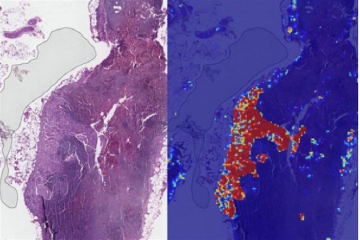 تشخیص سرطان سینه با دقت ۹۹ درصدی هوش مصنوعی