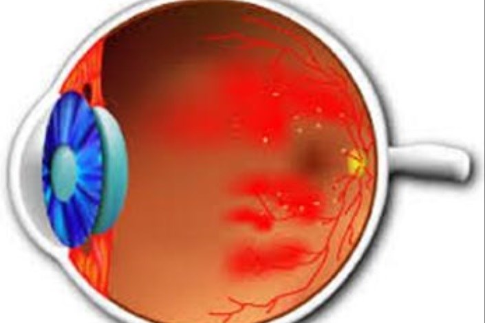 تولید آزمایشگاهی «مینی شبکیه» برای بازگرداندن بینایی