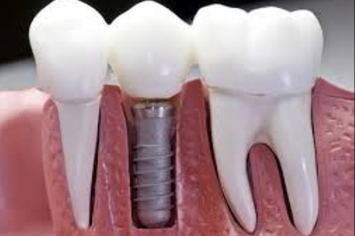 رفع وابستگی به نانوکامپوزیت دندانی توسط استارتاپی نوپا انجام شد