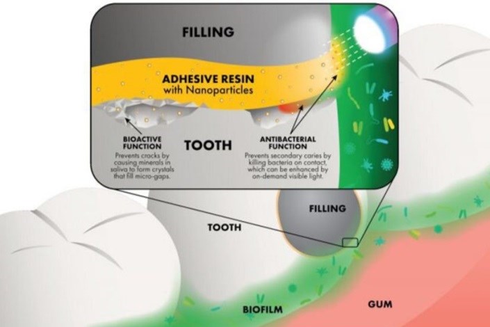 چسب پلیمری نانویی برای کمک به دندان‌پزشکان