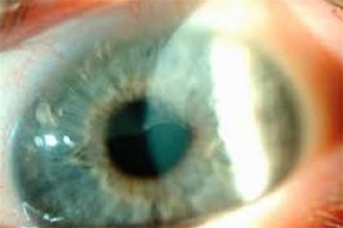 استفاده از بافت چشمی اهدایی و امیدواری در جراحی سلول های بنیادی