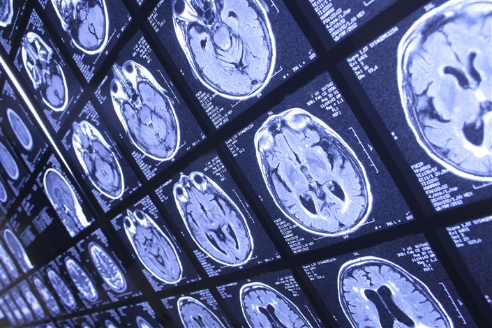 تشخیص دقیق سرطان مغز توسط هوش مصنوعی