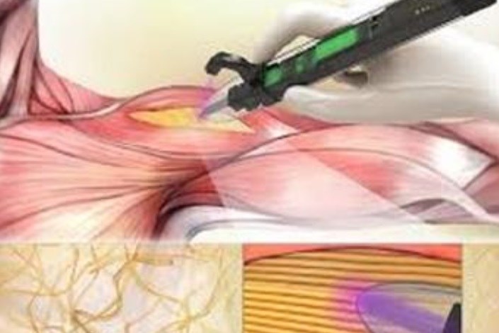درمان آسیب های عضلانی اسکلتی  با پرینترهای دستی سه بعدی