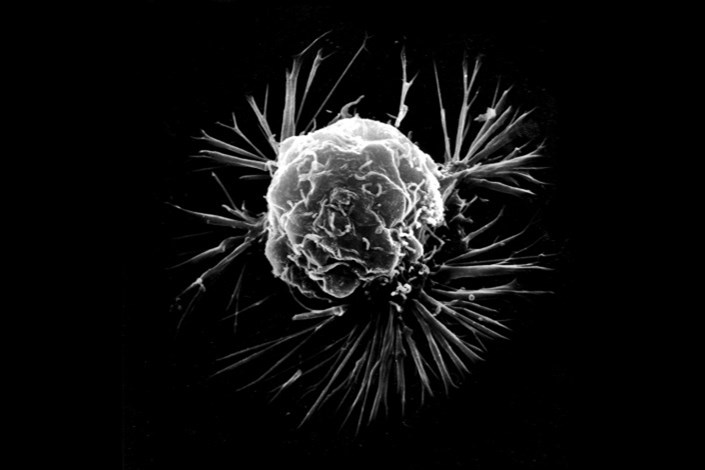 کشف تغییر متابولیسم سلول های سرطانی سینه