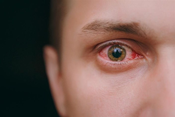 قرمزی چشم یکی از علائم مبتلایان به ویروس کرونا است
