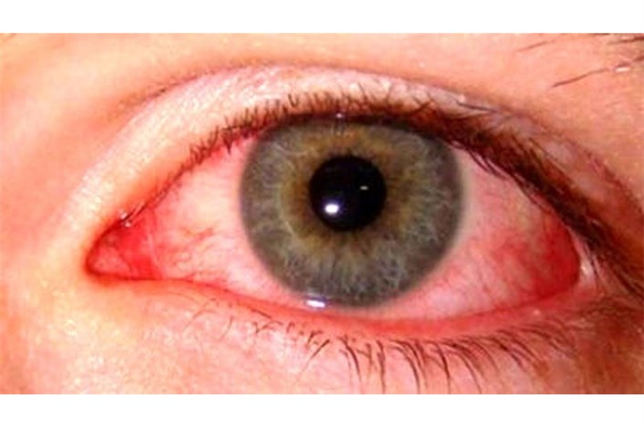 کرونا هیچ آسیبی به «بینایی» نمی‌زند/ نگران التهاب چشم ها نباشید