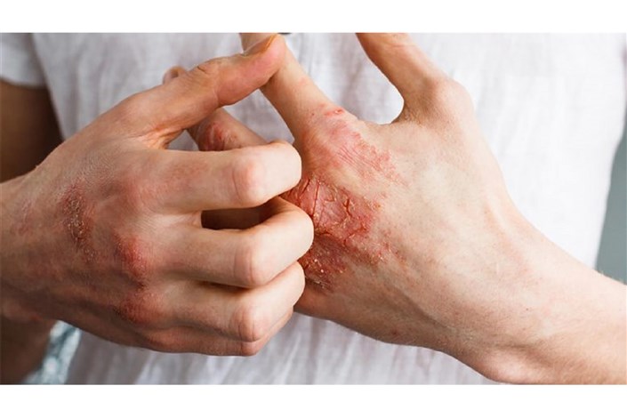 علل بروز عارضه‌های پوستی در برخی مبتلایان کرونا