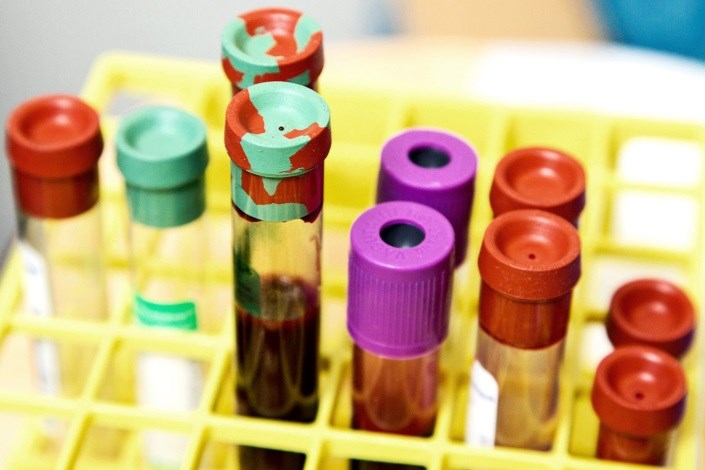 تشخیص آلزایمر با آزمایش ساده خون